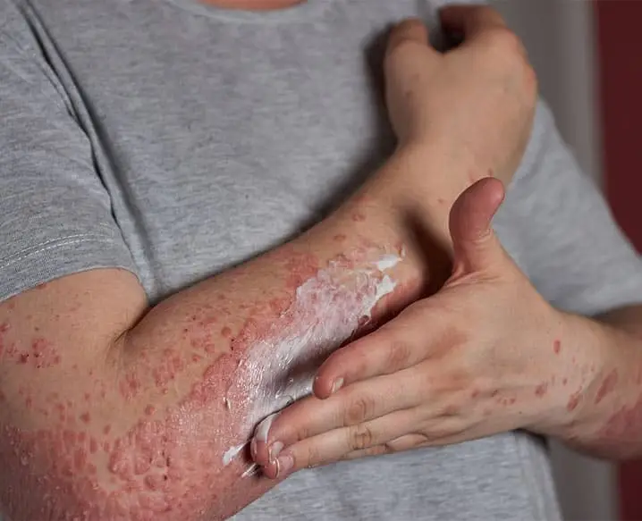 eczema treatment in Delhi
